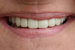 Close-up view of fixed bridge on dental implants
