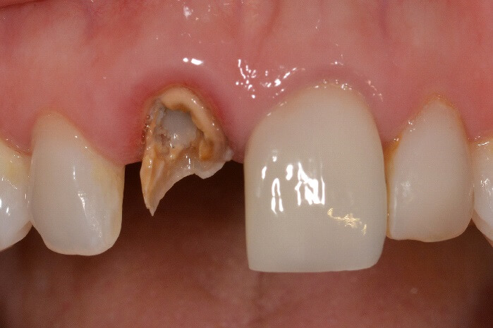 Broken tooth root still in gum