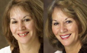 Portsmouth NH cosmetic veneers