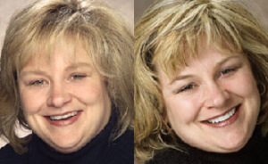 Portsmouth NH dental veneers