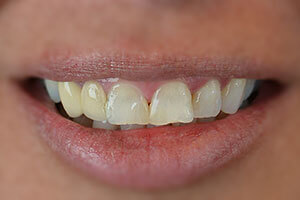 Dental Implants and veneers helped this patient to improve her smile.