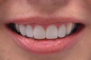 Smile rejuvenated with dental implants and veneers. Dentistry and lab work by Vitali Bondar, DDS - Portsmouth NH dentist.