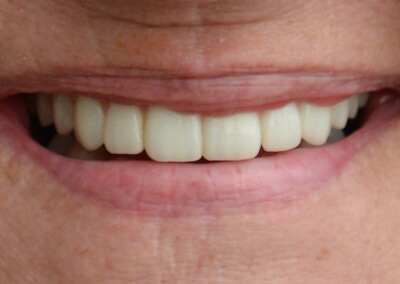 Close-up view of fixed bridge on 8 dental implants