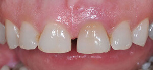 Dental veneers and implant