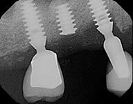 Dental implants can fracture