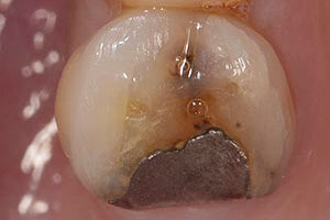 Failing Amalgam Filling