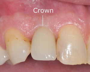 Dental Implant Crown is placed over a dental implants to look like a natural tooth.