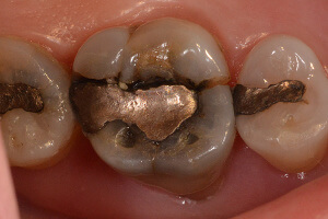 Fractured tooth, large amalgam filling.