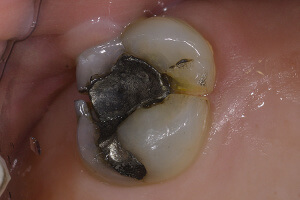 Fractured tooth was replaced with implant.