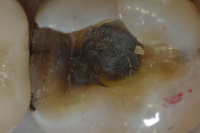 Fracture lines are visible after amalgam filling removal. Tooth needs a crown to prevent fracture.