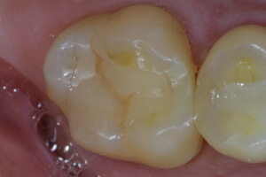 Composite filling placed 12 years ago by Vitali Bondar, DDS - Seacoast NH dentist.