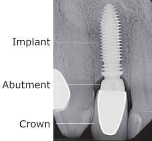 Dental Implant restored a missing front tooth.