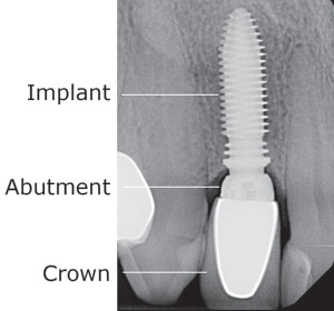 Dental Implant restored a missing teeth front tooth