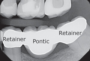 Implant is a better option than bridge