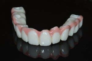Full arch fixed zirconia dental implant bridge