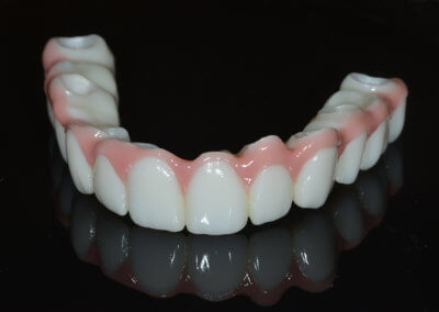 Full arch fixed zirconia dental implant bridge