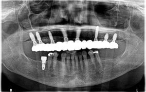Eight KAT dental implants and a permanent fixed bridge, placed by Vitali Bondar, DDS - New Hampshire implant dentist.