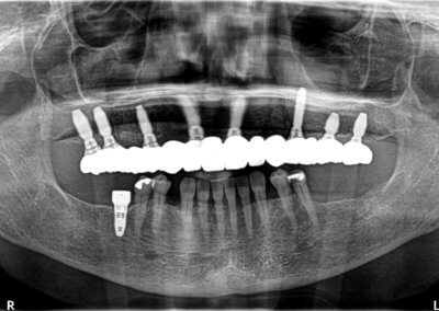 Eight KAT dental implants and a permanent fixed bridge, placed by Vitali Bondar, DDS - New Hampshire implant dentist.