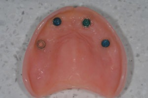 Upper denture with support from implants.