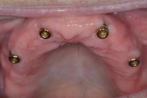 Dental implants placed same visit with full arch extractions. 