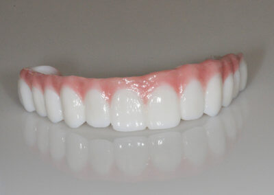 Layered zirconia bridge on 4 implants