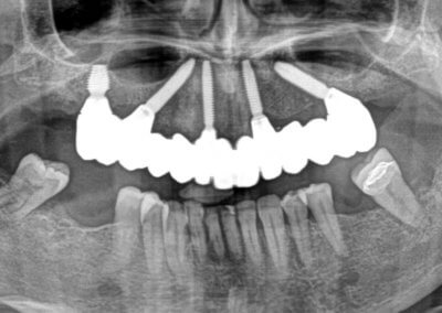 Upper fixed bridge on 5 implants x-ray