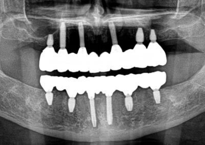 Upper and lower fixed implant bridges x-ray