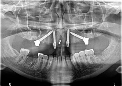 Panoramic x-ray at time of extractions and implant placement