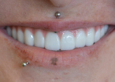 Zirconia bridge on 4 implants