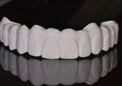 Colored zirconia bridge