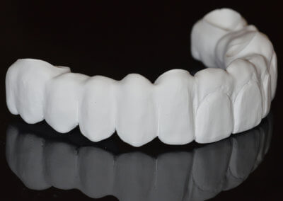 Milled zirconia bridge