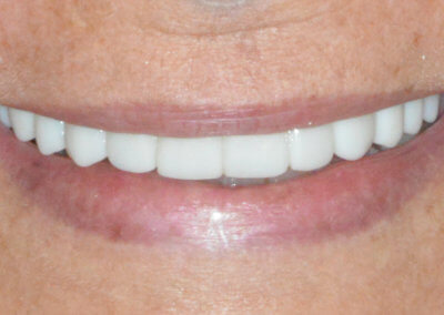 Upper 12 teeth bridge on 4 implants
