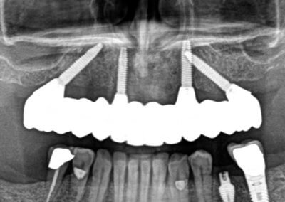 X-ray of finished bridge
