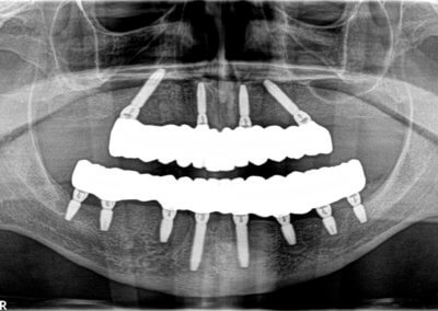 Fixed screw-retained upper and lower bridges on implants