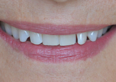 Upper porcelain veneers