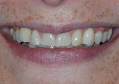 Worn misaligned teeth