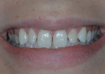 Gaps between teeth