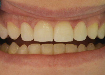 Two newly bonded veneers