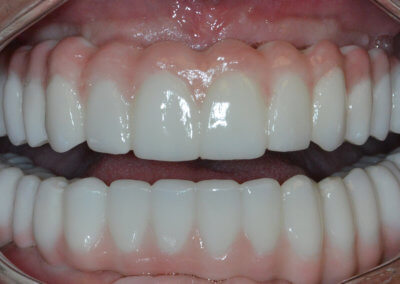 Upper and lower screw-retained bridges