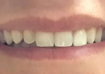 Oversized veneers