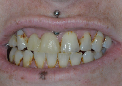 Before dental implant treatment