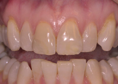 Gum recessions, misaligned teeth