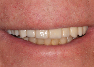 Upper cemented full arch bridge on six implants