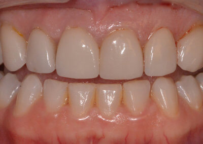 Patient was not happy with existing veneers