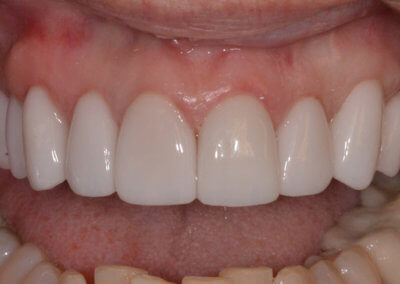 Gum grafts, ten porcelain veneers