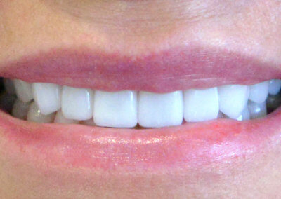 Upper next day porcelain veneers