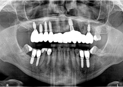 Upper cemented full arch bridge on six implants