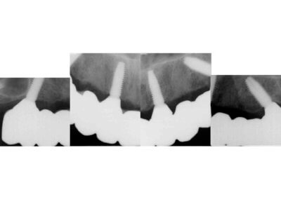 Upper full arch cemented bridge on four implants