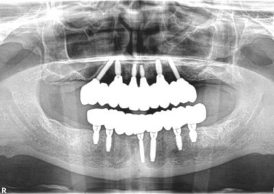 Upper cemented and lower screw-retained bridges