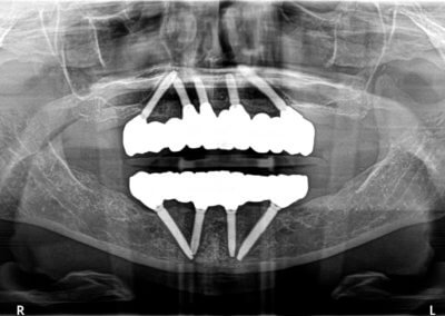 Upper and lower fixed bridges on implants